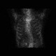 Adrenal metastasis and skeletal metastasis of pulmonary carcinoma, correlation, initial examination: X-ray - Plain radiograph